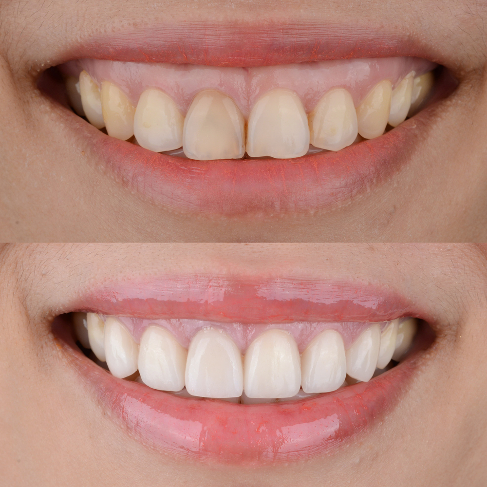 dental veneers