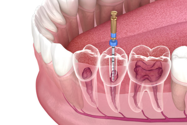 root canal treatment clifton tx