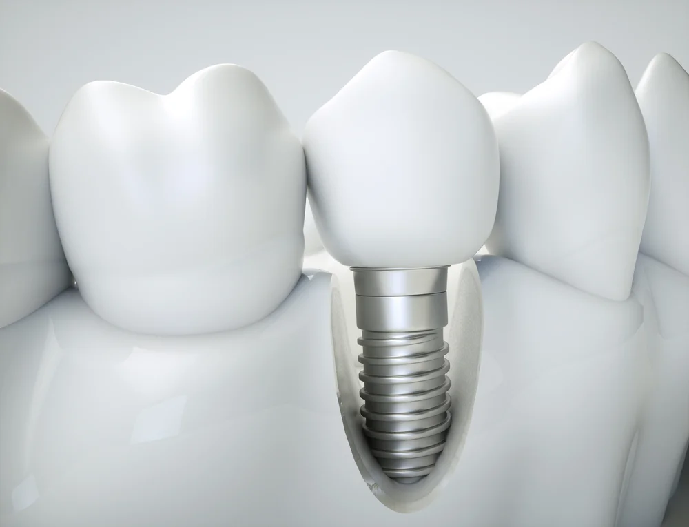 cost of dental implants