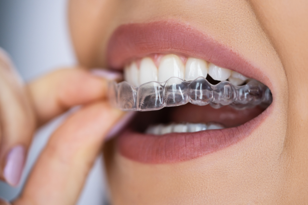 Exploring Alternatives to Invisalign: What Else Is Out There?