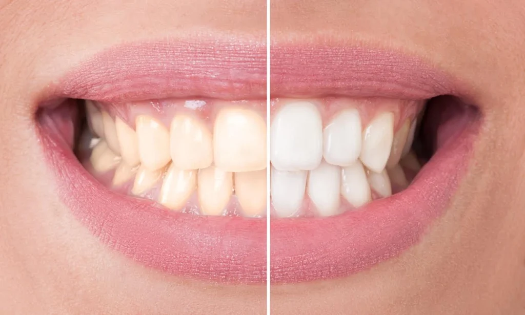 Take-Home Whitening Kits: Convenience Meets Effectiveness