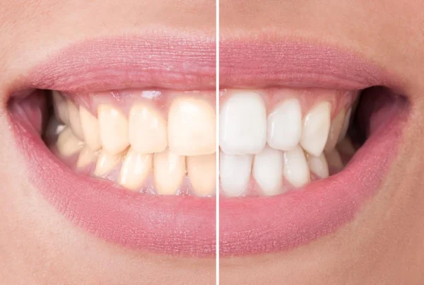 Take-Home Whitening Kits: Convenience Meets Effectiveness