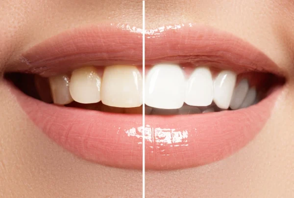 The Role of Whitening Toothpaste in Everyday Care