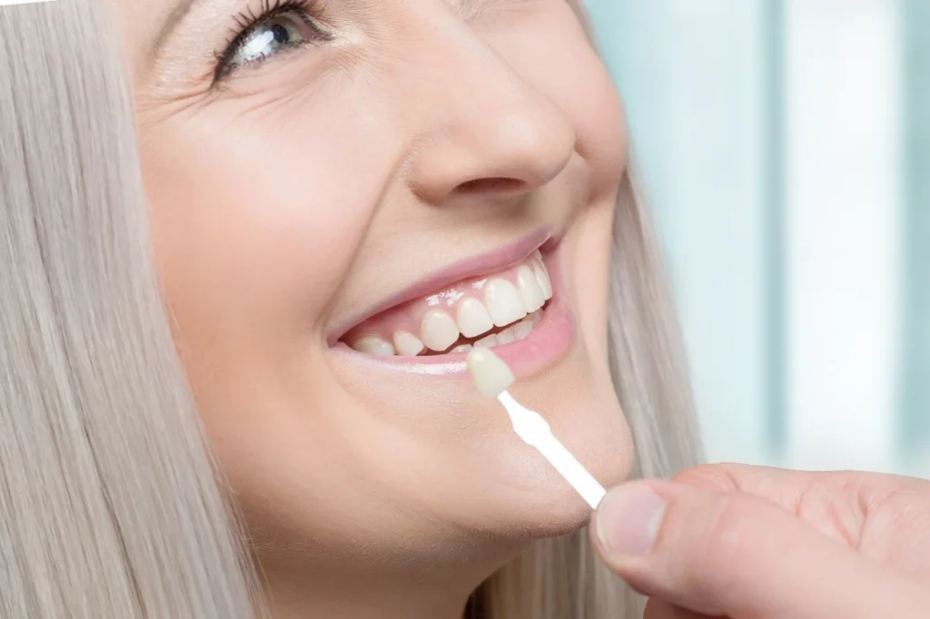 Veneers Explained: Types, Benefits, and Costs