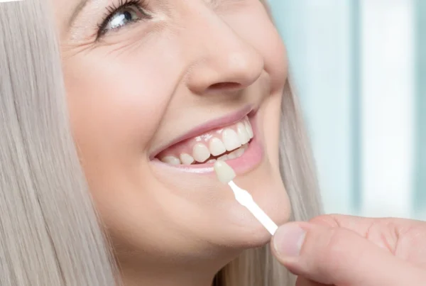 Veneers Explained: Types, Benefits, and Costs