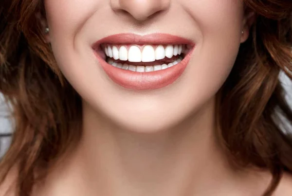 Replacing Veneers: When and Why You Should Consider It