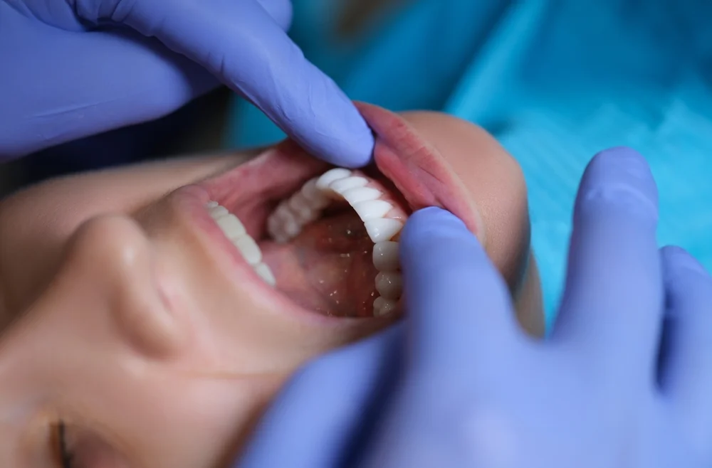 Composite Veneers Price: Affordable Alternatives Explained