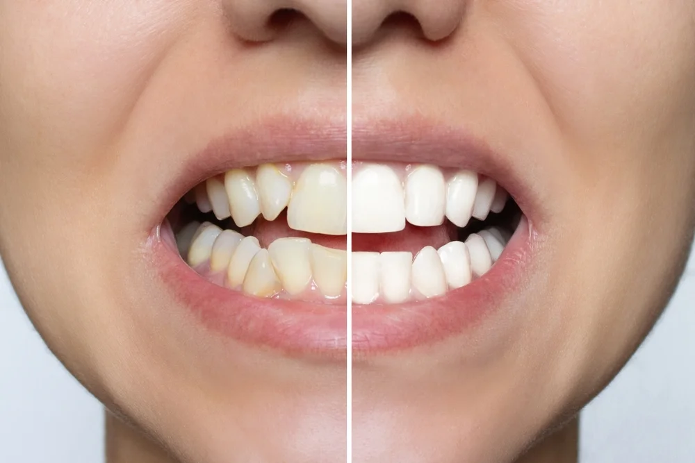 Are Veneers Covered by Dental Insurance? The Real Story